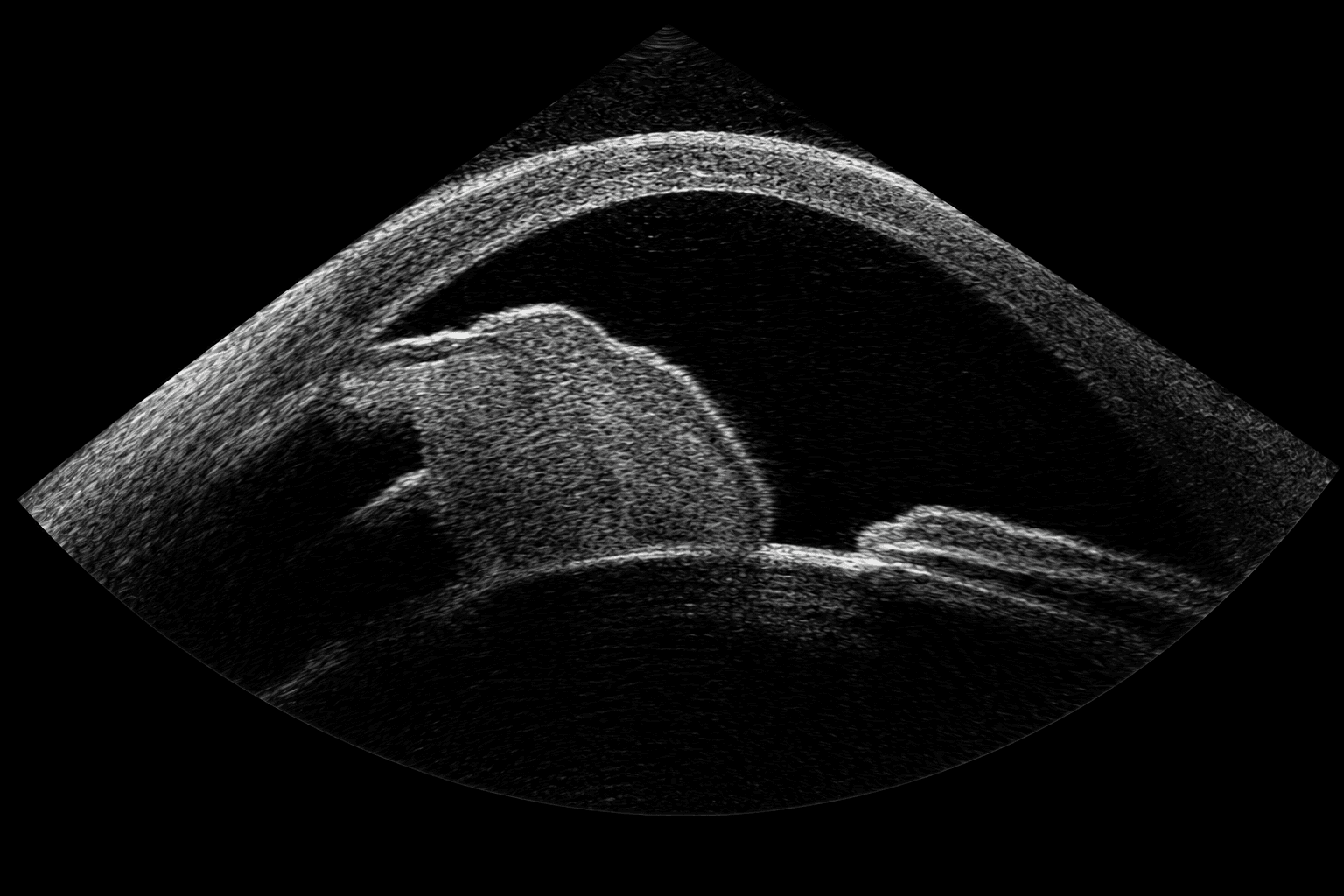 Ultrasound Biomicroscopy (UBM)