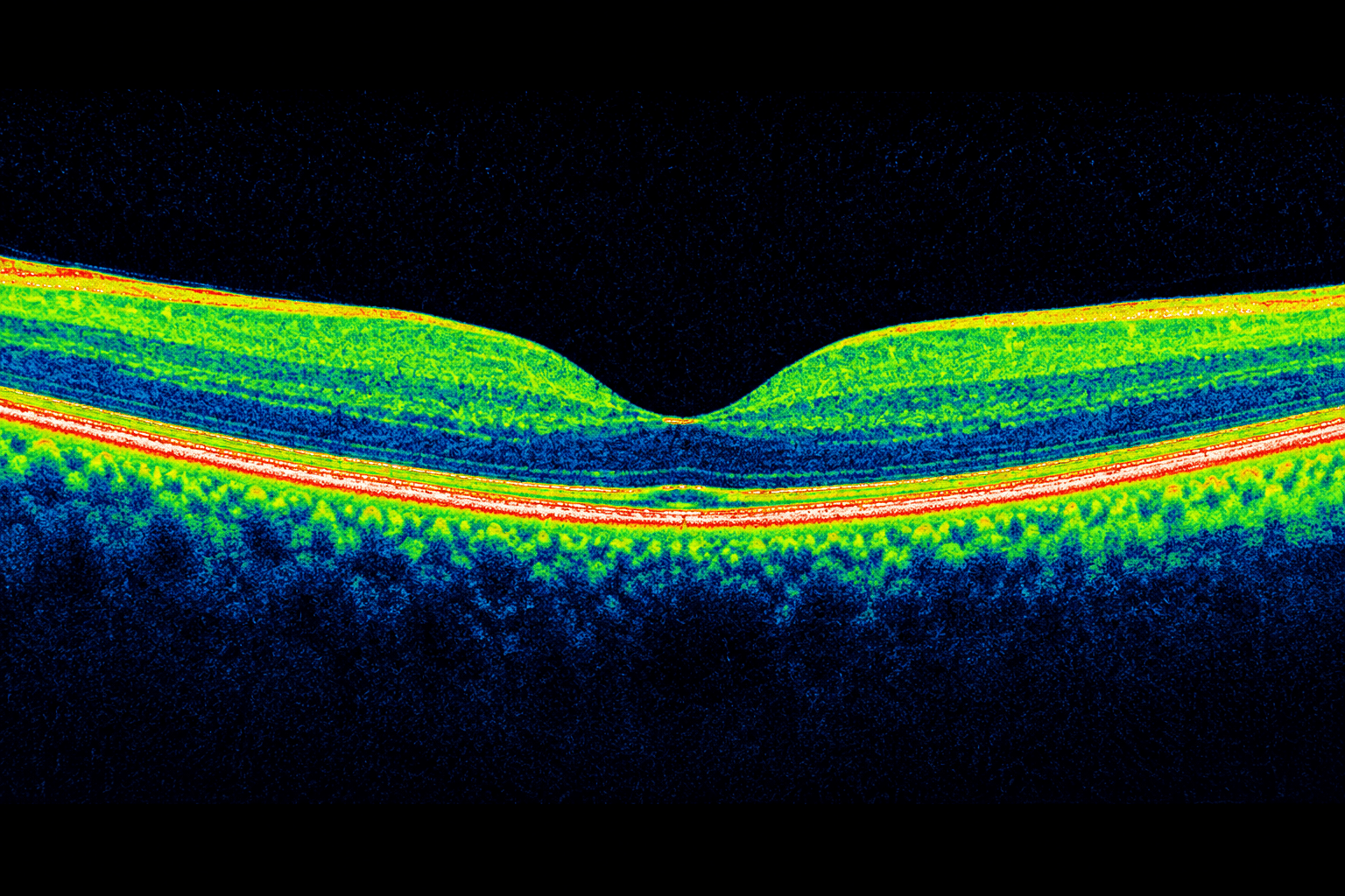 Optical Coherence Tomography (OCT)